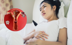 Đột phá điều trị lạc nội mạc tử cung bằng sóng cao tần