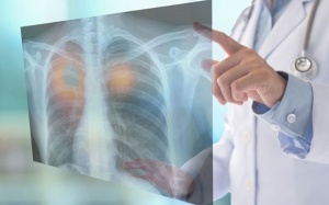 Dấu hiệu nhận biết u phổi lành tính và ác tính