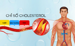 Tăng cholesterol kéo dài: Mối nguy âm thầm thúc đẩy xơ vữa động mạch