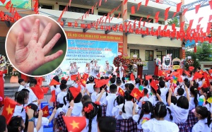 Bộ Y tế cảnh báo gia tăng bệnh tay chân miệng trong mùa tựu trường