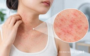 Phát ban do nhiệt: Nhận biết và xử lý thế nào?