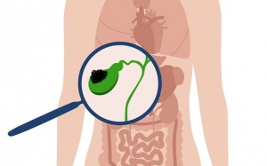 Đa polyp túi mật 9x8mm nên xử trí thế nào?
