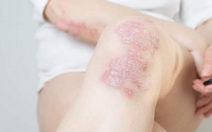 Chủ động kiểm soát vảy nến từ sớm để không lo bệnh bùng phát khi trời lạnh