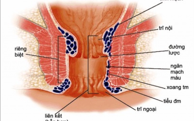 Thể dục cho người bị bệnh trĩ