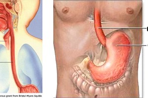 Trào ngược dạ dày thực quản dễ dẫn đến ung thư
