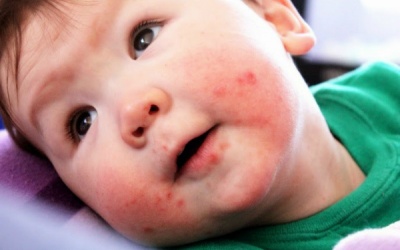 Hà Nội có 50 trường hợp mắc bệnh tay chân miệng