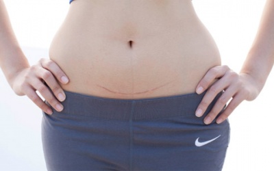 Chủ động sinh mổ - Coi chừng tai biến! 