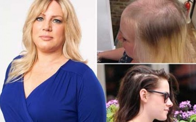 Chữa hói bằng tế bào gốc