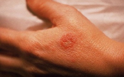 Từ bệnh da lan ra bệnh tim, đột quỵ