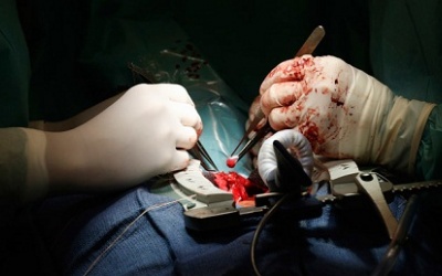 Chữa truỵ tim bằng tế bào gốc