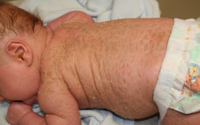 Đông y trị bệnh vảy cá mùa hanh khô 