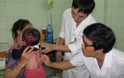 Năm nay,  thủy đậu 'ghé thăm' sớm   