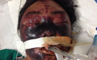 Biểu hiện có thể bạn mắc bệnh liên cầu lợn