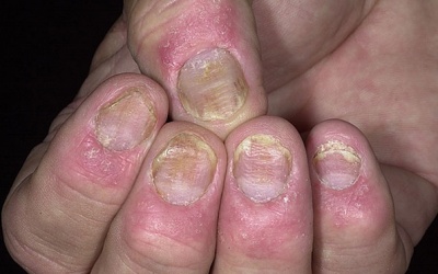 Làm sao điều trị hết nấm móng tay?