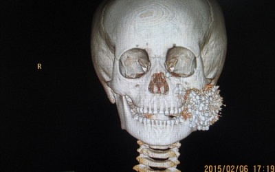 Cậu bé 6 tuổi nát mặt vì súng hơi