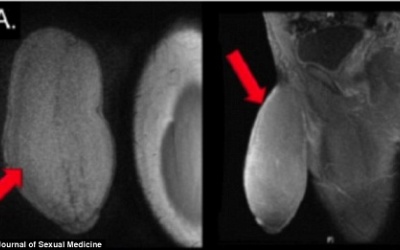 Phẫu thuật cắt bớt vì súng to như đại bác!