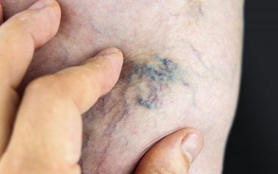 Thiết bị mới điều trị giãn tĩnh mạch