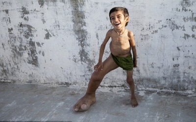 Bàn chân khủng không rõ nguyên nhân