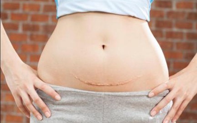 Sinh mổ bao lâu thì có thể mang thai?