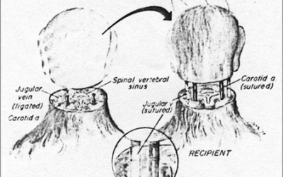 Đầu đứt lìa vẫn có thể cấy ghép?