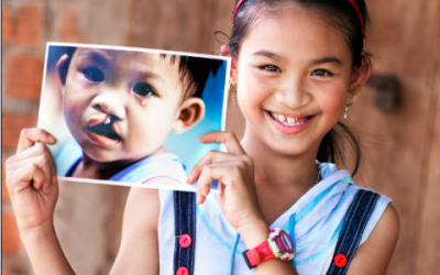 Phẫu thuật miễn phí trẻ hở hàm ếch vào tháng 3