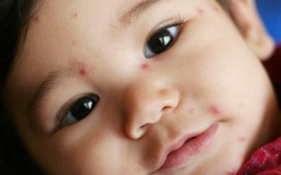 Sau Tết, nhiều trẻ nhập viện vì thủy đậu