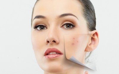 Sạch mụn, tươi tắn đón 8/3