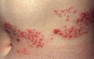 Bạn biết gì về bệnh “giời leo”?