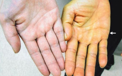 Vàng da, vàng mắt có phải bệnh viêm gan?