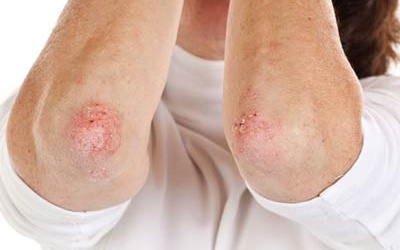 Người bị bệnh vảy nến nên ăn uống như thế nào?