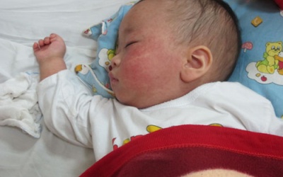 Bé bị sởi có cần kiêng tắm?