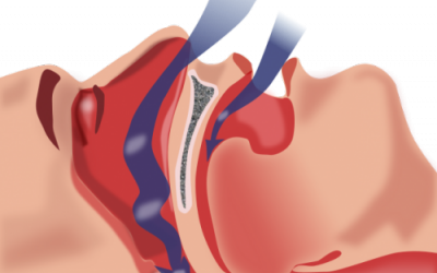 Người ngủ ngáy dễ gây... tai nạn giao thông