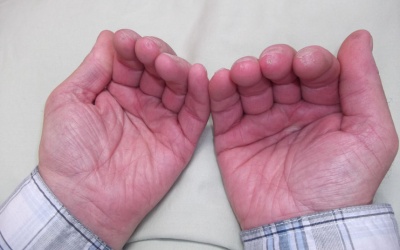 Nhìn tay bắt bệnh