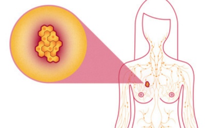 Infographic: Dấu hiệu nhận biết bệnh ung thư vú