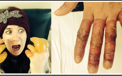 Cô gái suýt mất đôi tay vì say xỉn