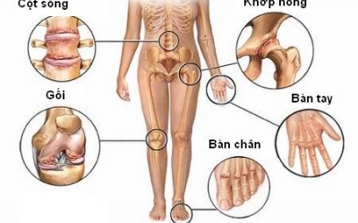 Điều trị thoái hóa khớp theo Đông y