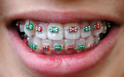 Niềng răng có nguy hiểm không?