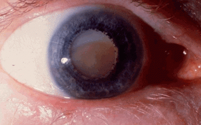 Nguyên nhân nào gây đục thủy tinh thể?