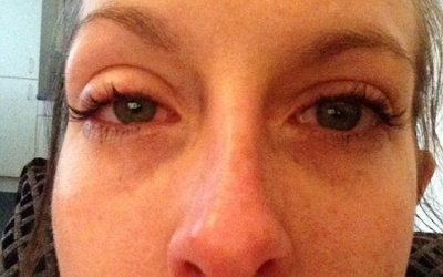 Gần như mù mắt vì kính áp tròng