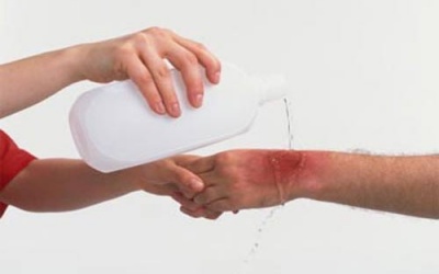 Sơ cứu khi trẻ bị bỏng như thế nào?