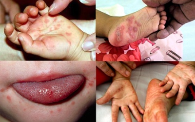 Bệnh tay chân miệng: Lây lan nhanh, dễ thành dịch