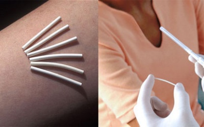 Cấy que tránh thai có an toàn không?
