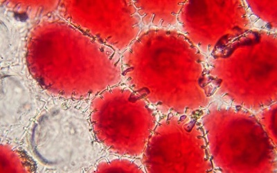 7 thói quen nguy hiểm khiến bạn dễ mắc ung thư