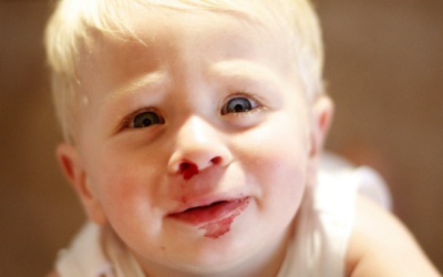 Bé bị chảy máu cam nhiều là bệnh gì?