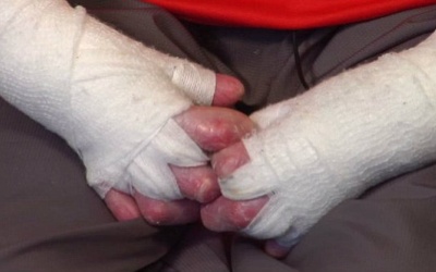 Cậu bé 14 tuổi mắc bệnh da mỏng như cánh bướm