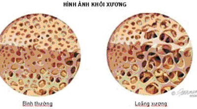 Loãng xương ngay khi còn trẻ