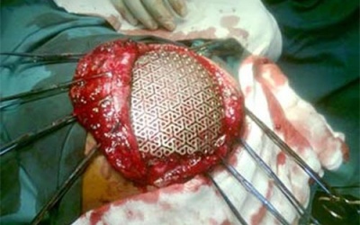 Tái tạo hộp sọ người bằng… kim loại