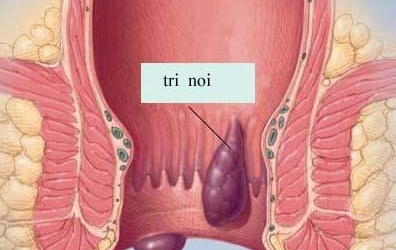 Bệnh trĩ - đau này biết kể cùng ai