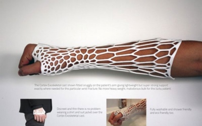 Bó bột bằng khung vật liệu in 3D