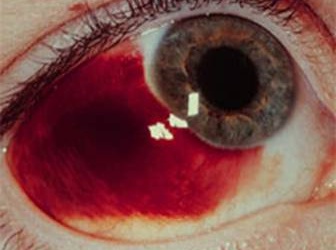 Chảy máu mắt - Tai nạn không hiếm gặp